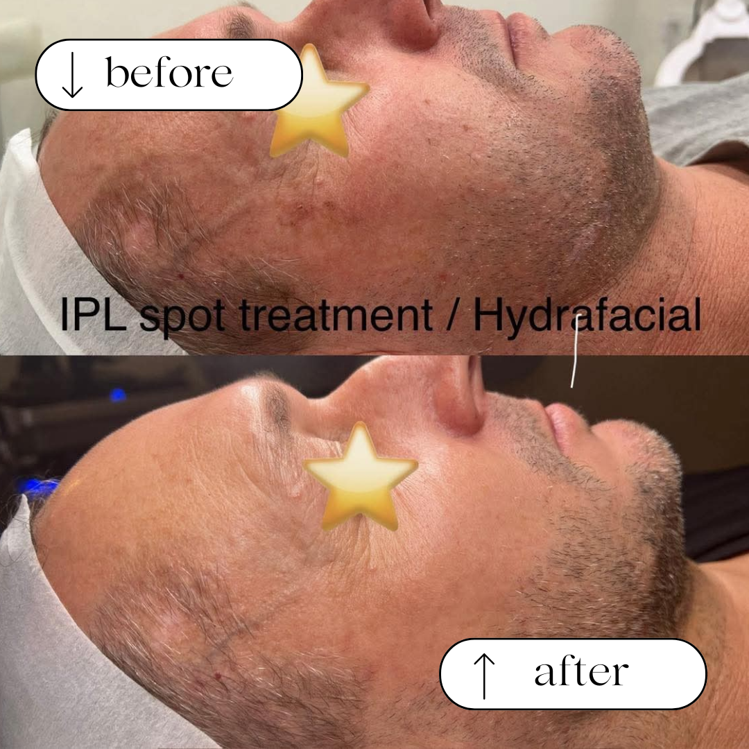 Body Wisdom Perth before and after treatment result