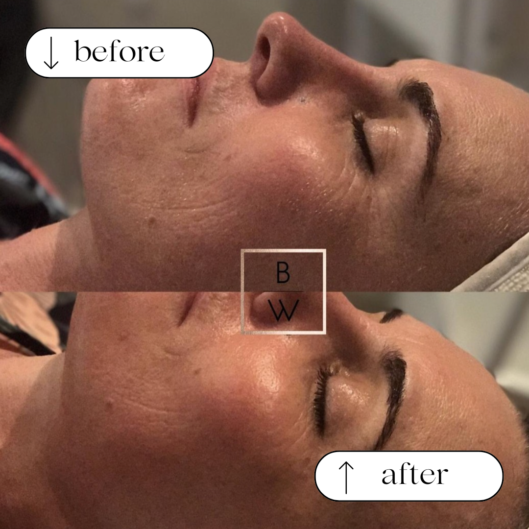 Body Wisdom Perth before and after treatment result