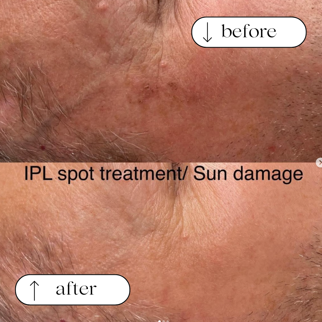Body Wisdom Perth before and after treatment result