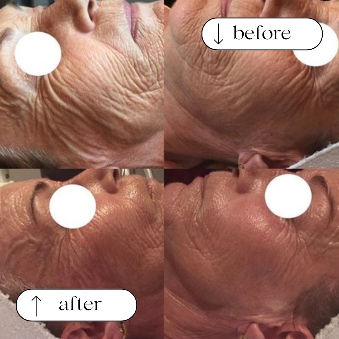 Body Wisdom Perth before and after treatment result